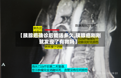【胰腺癌确诊后能活多久,胰腺癌刚刚就发现了有救吗】-第3张图片