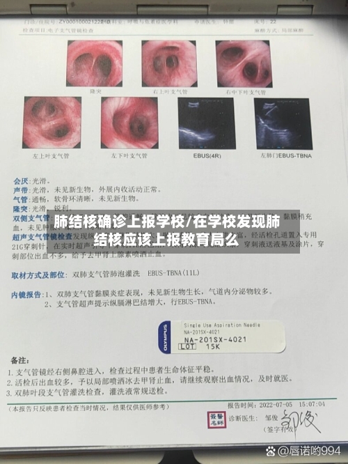 肺结核确诊上报学校/在学校发现肺结核应该上报教育局么-第2张图片