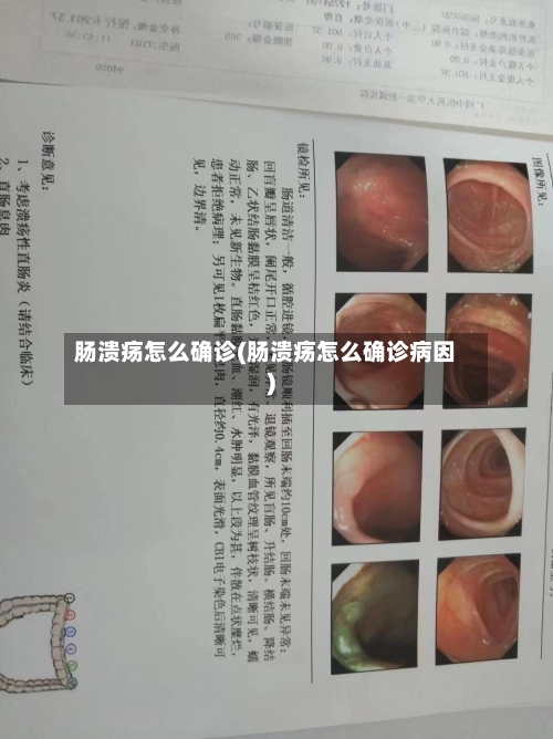 肠溃疡怎么确诊(肠溃疡怎么确诊病因)