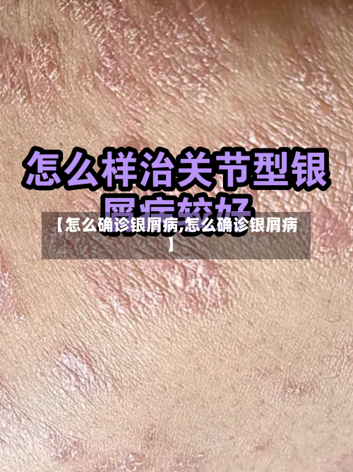【怎么确诊银屑病,怎么确诊银屑病】
