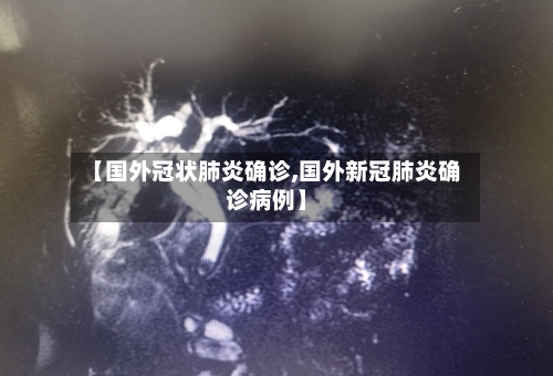 【国外冠状肺炎确诊,国外新冠肺炎确诊病例】-第2张图片