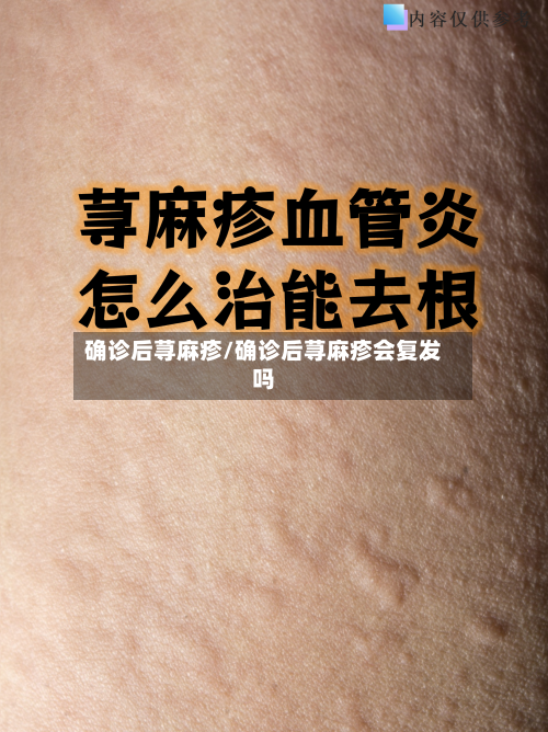 确诊后荨麻疹/确诊后荨麻疹会复发吗