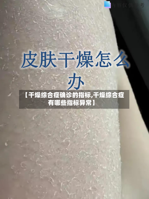 【干燥综合症确诊的指标,干燥综合症有哪些指标异常】-第2张图片