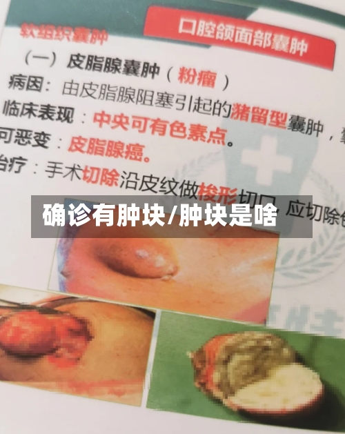 确诊有肿块/肿块是啥