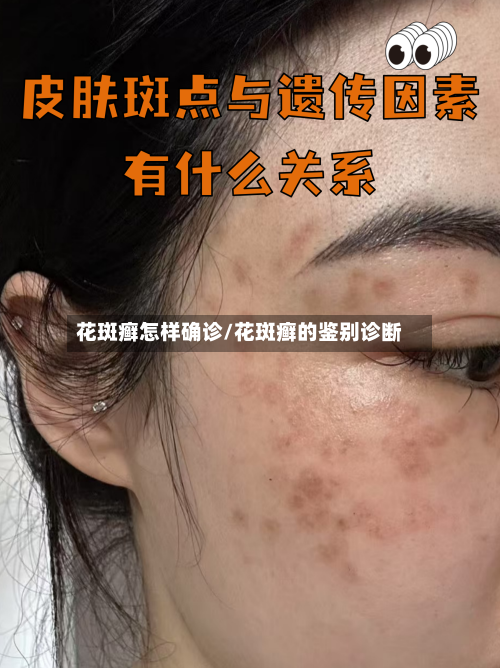 花斑癣怎样确诊/花斑癣的鉴别诊断
