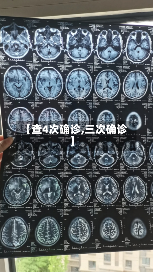 【查4次确诊,三次确诊】