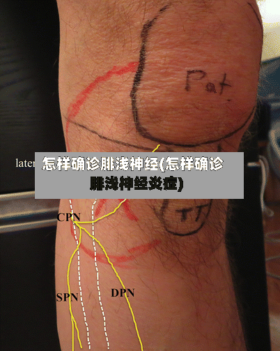 怎样确诊腓浅神经(怎样确诊腓浅神经炎症)-第2张图片