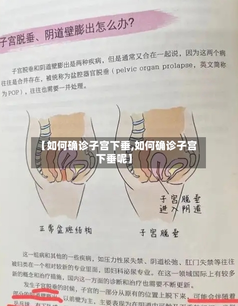 【如何确诊子宫下垂,如何确诊子宫下垂呢】