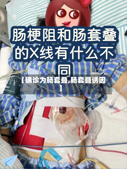 【确诊为肠套叠,肠套叠诱因】-第1张图片