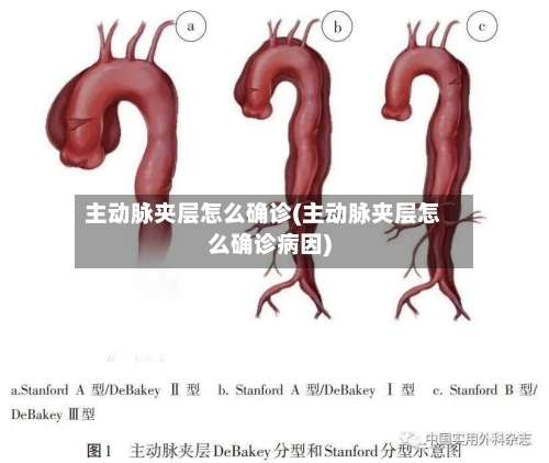 主动脉夹层怎么确诊(主动脉夹层怎么确诊病因)-第1张图片