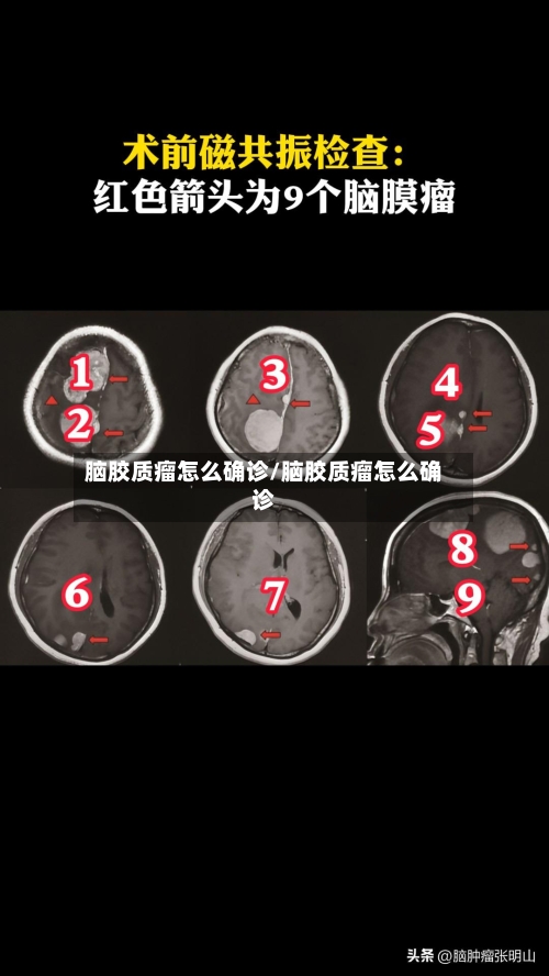 脑胶质瘤怎么确诊/脑胶质瘤怎么确诊