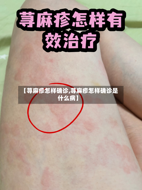 【荨麻疹怎样确诊,荨麻疹怎样确诊是什么病】