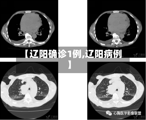 【辽阳确诊1例,辽阳病例】