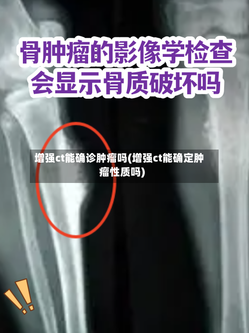增强ct能确诊肿瘤吗(增强ct能确定肿瘤性质吗)-第1张图片