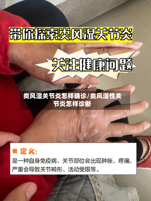类风湿关节炎怎样确诊/类风湿性关节炎怎样诊断-第3张图片