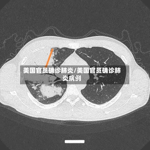 美国官员确诊肺炎/美国官员确诊肺炎病例-第2张图片