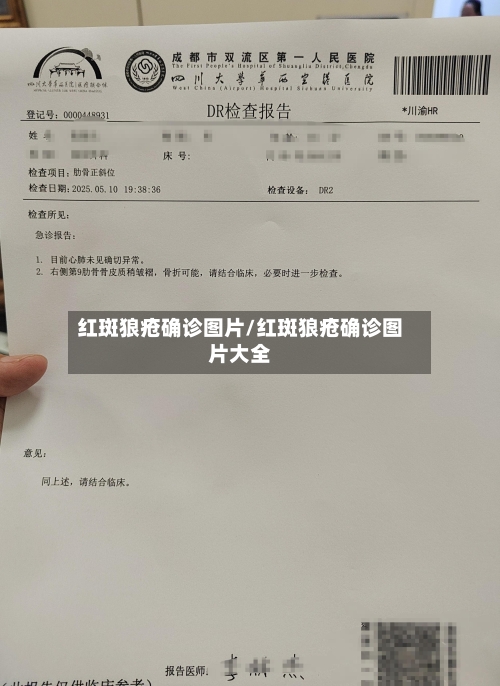 红斑狼疮确诊图片/红斑狼疮确诊图片大全-第3张图片