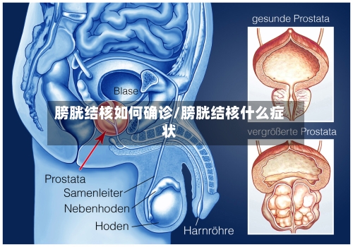 膀胱结核如何确诊/膀胱结核什么症状-第2张图片
