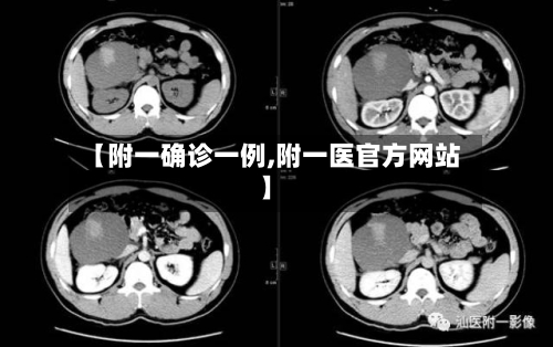 【附一确诊一例,附一医官方网站】-第3张图片