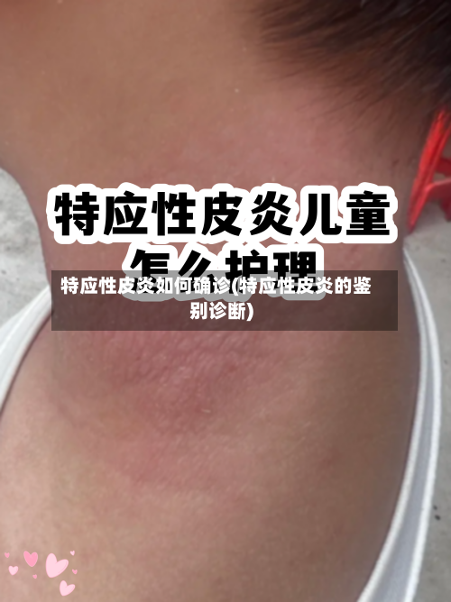 特应性皮炎如何确诊(特应性皮炎的鉴别诊断)