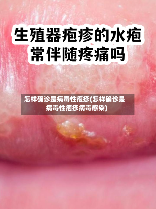 怎样确诊是病毒性疱疹(怎样确诊是病毒性疱疹病毒感染)