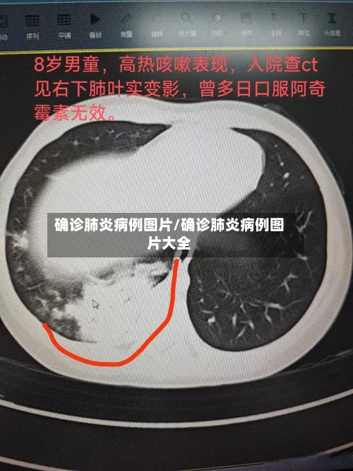确诊肺炎病例图片/确诊肺炎病例图片大全-第2张图片