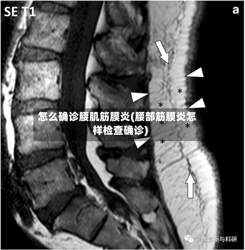 怎么确诊腰肌筋膜炎(腰部筋膜炎怎样检查确诊)-第2张图片