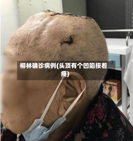 柳林确诊病例(头顶有个凹陷按着疼)-第2张图片