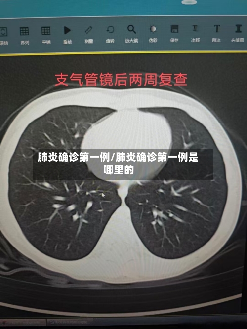 肺炎确诊第一例/肺炎确诊第一例是哪里的