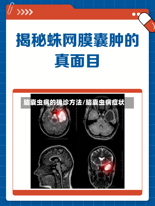 脑囊虫病的确诊方法/脑囊虫病症状-第3张图片