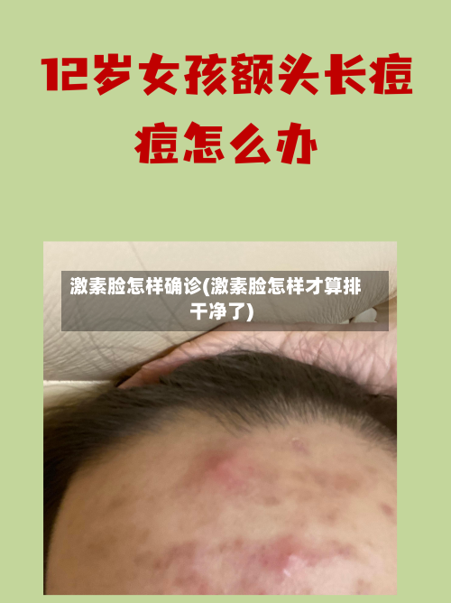 激素脸怎样确诊(激素脸怎样才算排干净了)